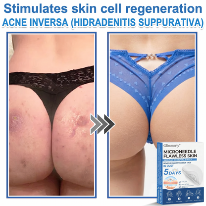 Glimmerly®🌲 2-in-1 Microneedle & Hydrocolloid Patch | Raised Moles,Acne,  Flat Warts & Skin Tags Remover | Improves Wrinkles, Scars & Blemishes | Invisible Pimple Patches for Face & Body | 144 Count