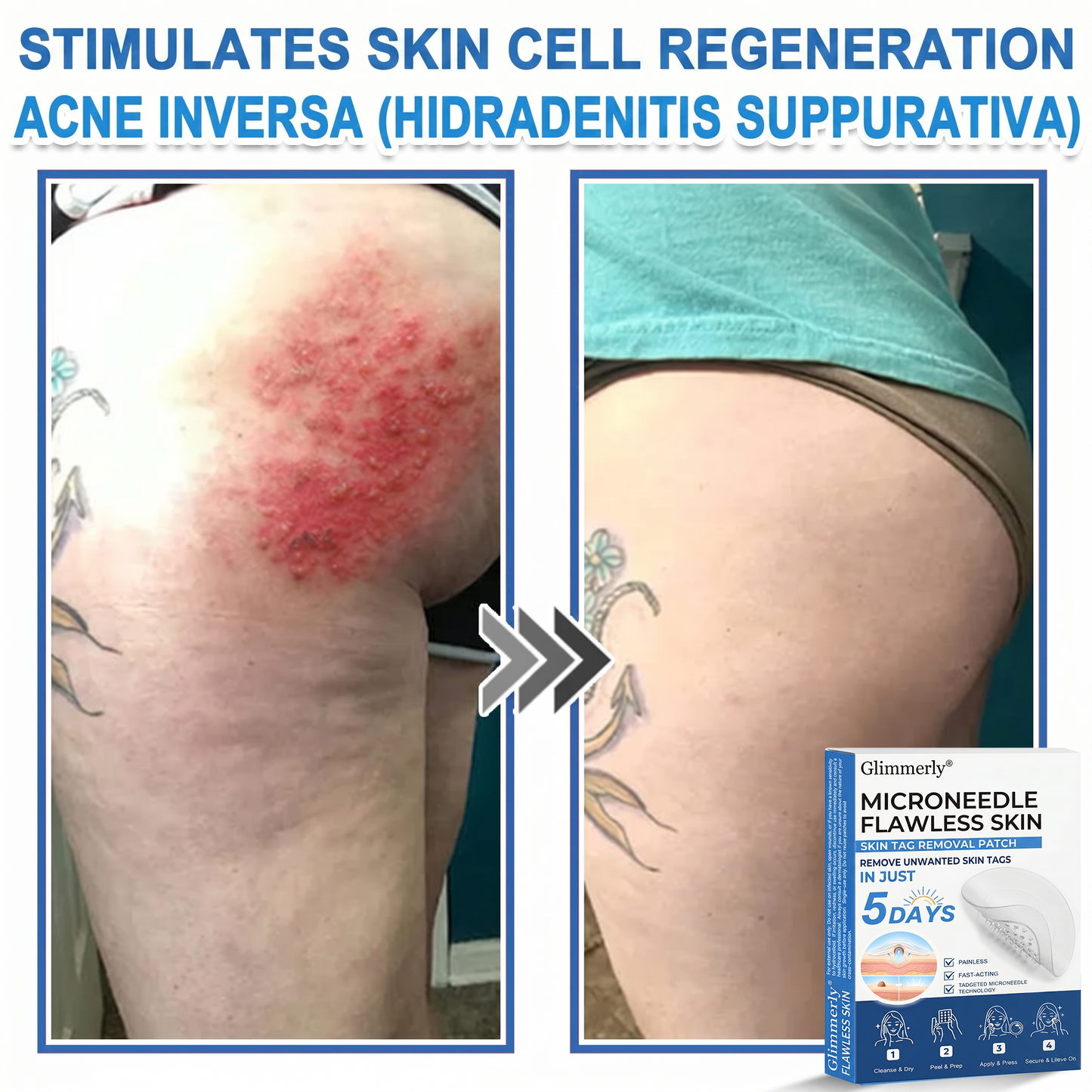 Glimmerly®🌲 2-in-1 Microneedle & Hydrocolloid Patch | Raised Moles,Acne,  Flat Warts & Skin Tags Remover | Improves Wrinkles, Scars & Blemishes | Invisible Pimple Patches for Face & Body | 144 Count