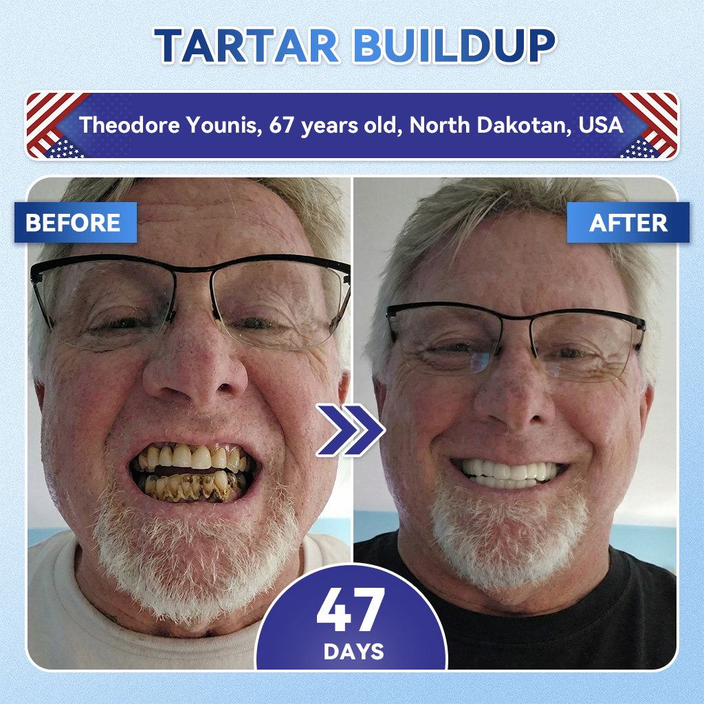 𝑮𝒍𝒊𝒎𝒎𝒆𝒓𝒍𝒚® 🎋 Tideglusib Fast‑Dissolving Tooth & Gum Repair Oral Strips(Supports tooth repair and helps relieve gum discomfort and other common oral concerns)