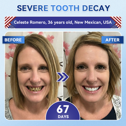 𝑮𝒍𝒊𝒎𝒎𝒆𝒓𝒍𝒚® 🎋 Tideglusib Fast‑Dissolving Tooth & Gum Repair Oral Strips(Supports tooth repair and helps relieve gum discomfort and other common oral concerns)