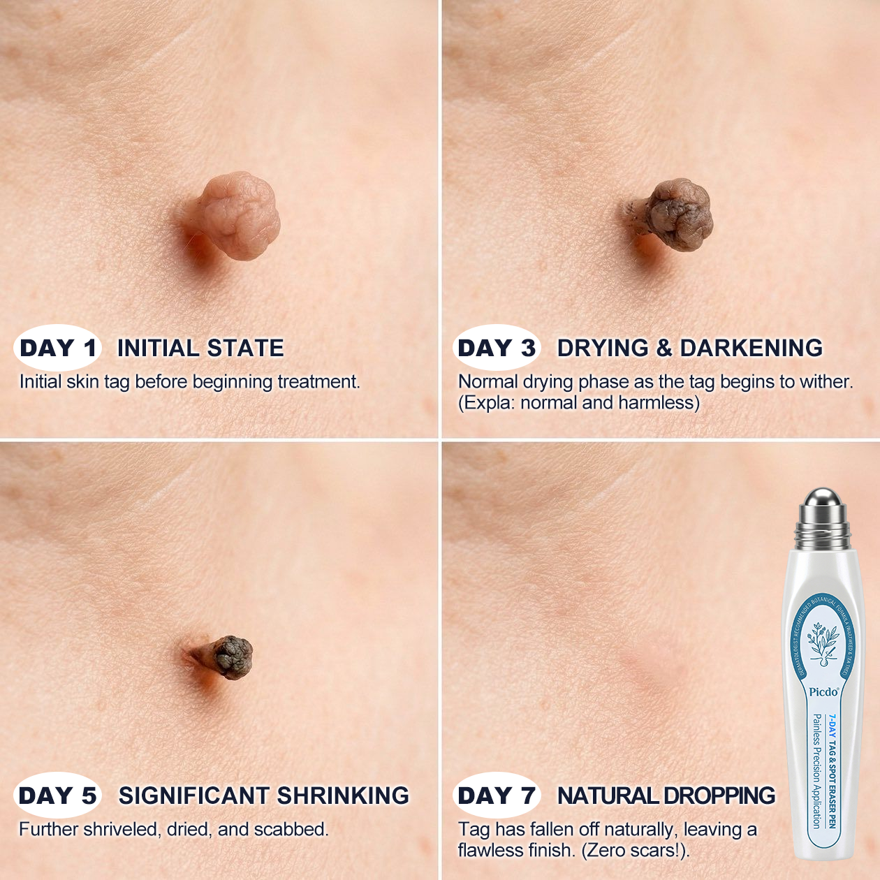 𝐏i𝐜𝐝o® 7-𝐷𝑎𝑦 𝗧𝐚𝐠 & 𝗦𝗽𝐨𝐭 𝐄𝐫𝒂𝒔𝒆𝒓(Zero Pain, Zero 𝐒𝐜𝐚𝒓𝒔 Rollerball)🌲