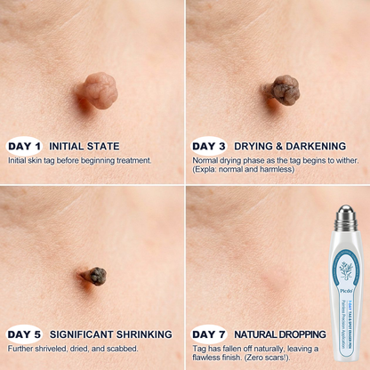 𝐏i𝐜𝐝o® 7-𝐷𝑎𝑦 𝗧𝐚𝐠 & 𝗦𝗽𝐨𝐭 𝐄𝐫𝒂𝒔𝒆𝒓(Zero Pain, Zero 𝐒𝐜𝐚𝒓𝒔 Rollerball)🌲
